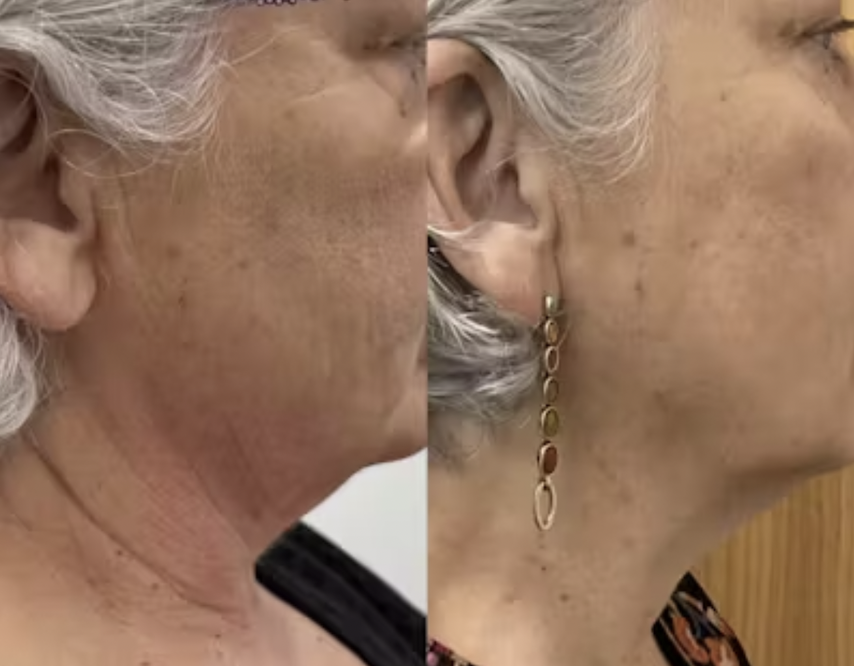 A patient shows her before and after of Forma, one of our facials in Cedar Park options.