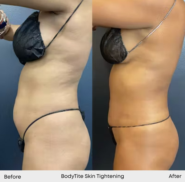 BodyTite Skin Tightening - before and after