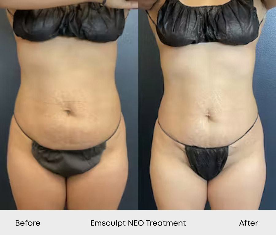 Emsculpt NEO Before and After