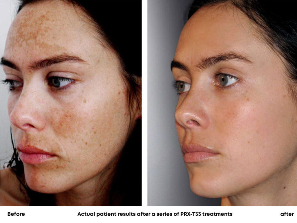 Actual patient results after a series of PRX-T33 treatments