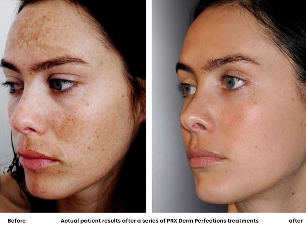 Actual patient results after a series of PRX-Derm Perfections treatments