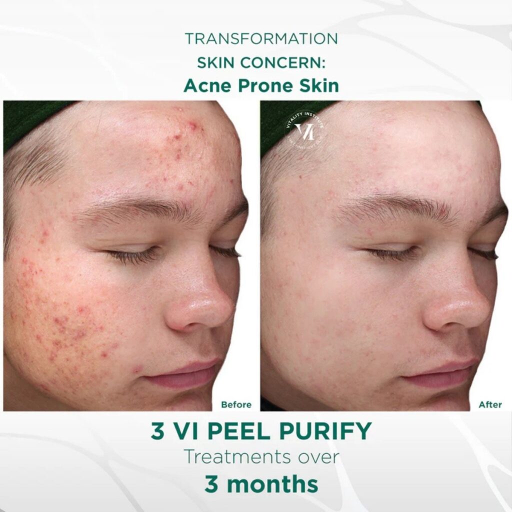 VI Peel Purify Before and After