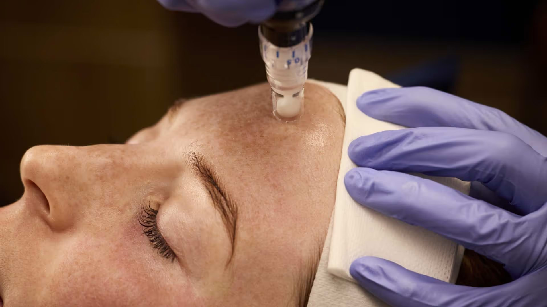 SkinPen Microneedling in Austin