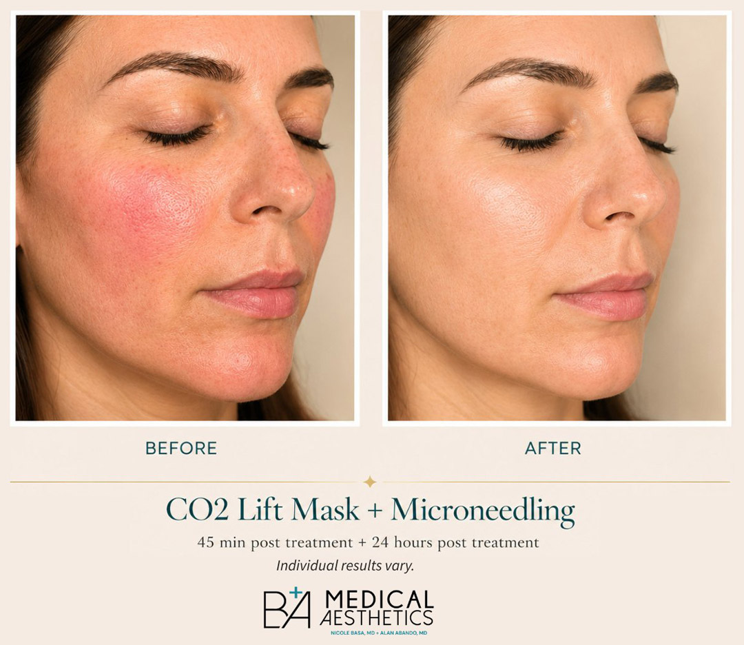 CO2Lift Mask with Microneedling after 24hrs of treatment 
