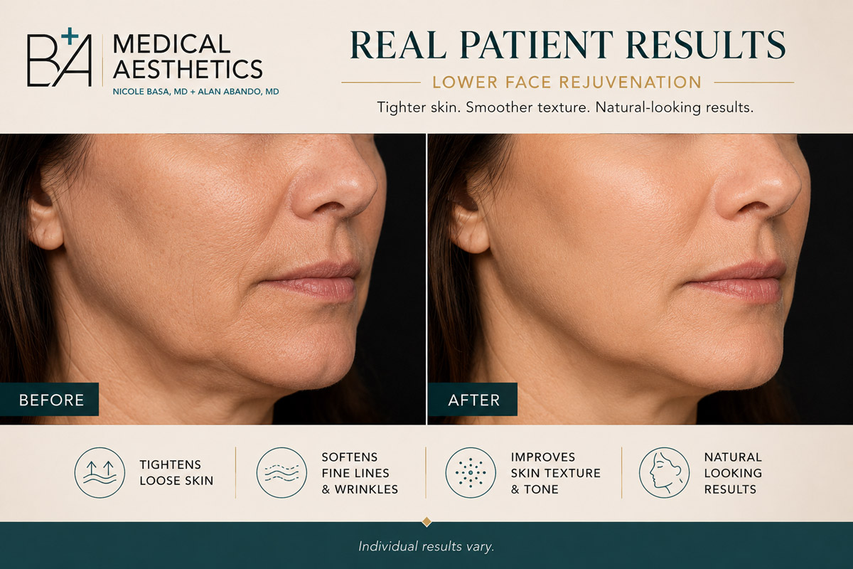 Morpheus8 before and after — lower face rejuvenation, tighter and smoother skin — B+A Medical Center Cedar Park Austin TX