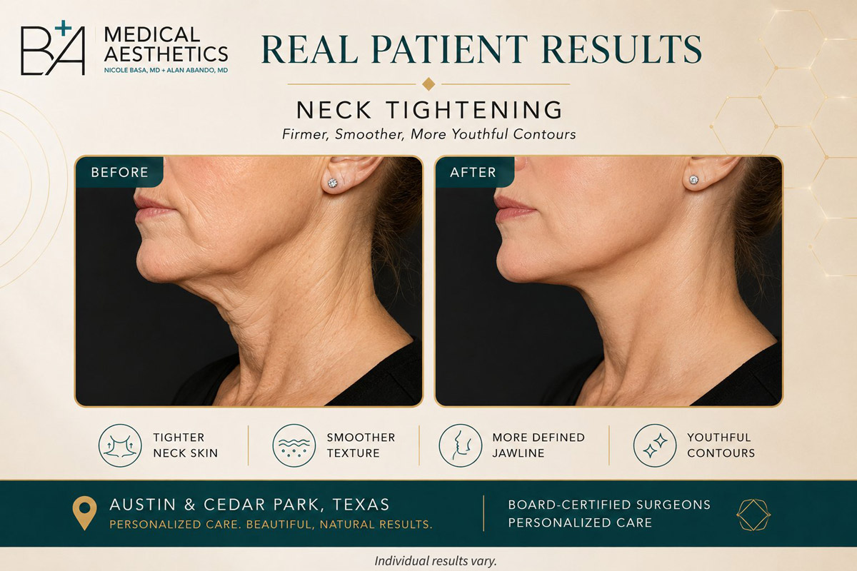 Morpheus8 before and after neck tightening, firmer and more defined contours — B+A Medical Center Cedar Park Austin TX
