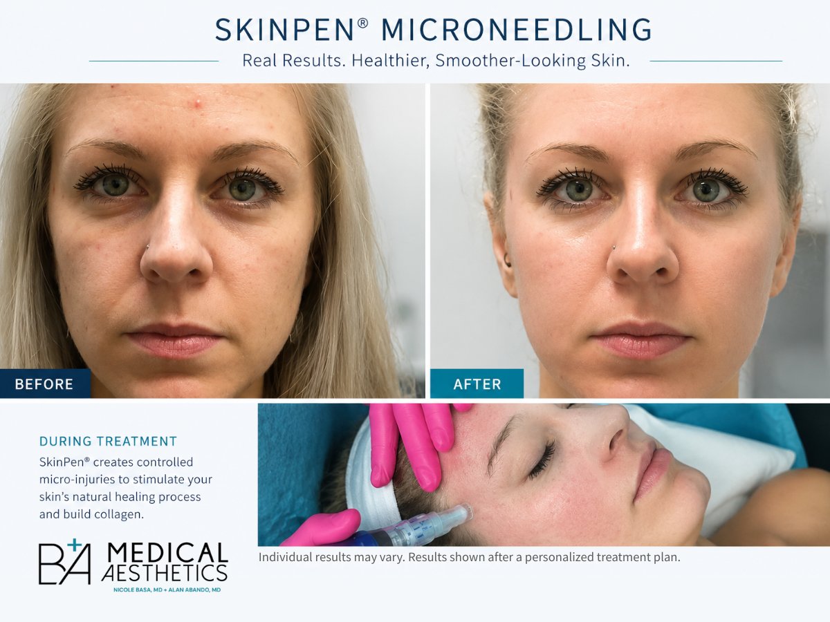 Before and after SkinPen microneedling treatment showing smoother, healthier-looking skin at B+A Medical Aesthetics in Austin.