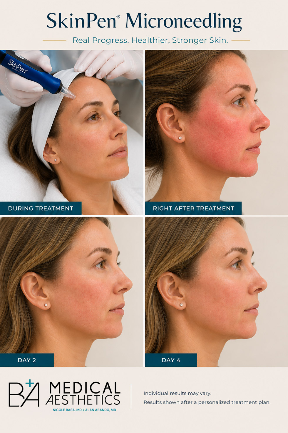 SkinPen microneedling recovery timeline showing skin immediately after treatment and the healing process through Day 4 at B+A Medical Aesthetics in Austin.